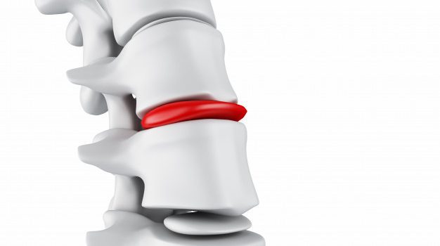 Slipped disc treatment