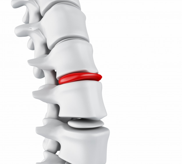Slipped disc treatment