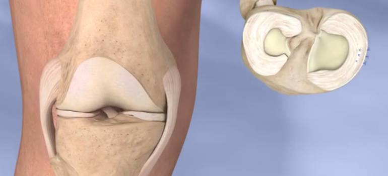 The Treatment and Recovery of Meniscus Tear