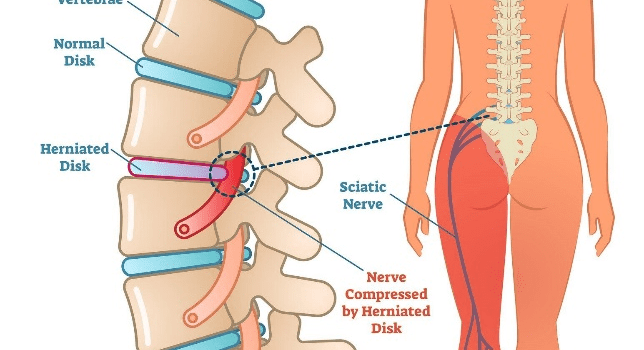 sciatica