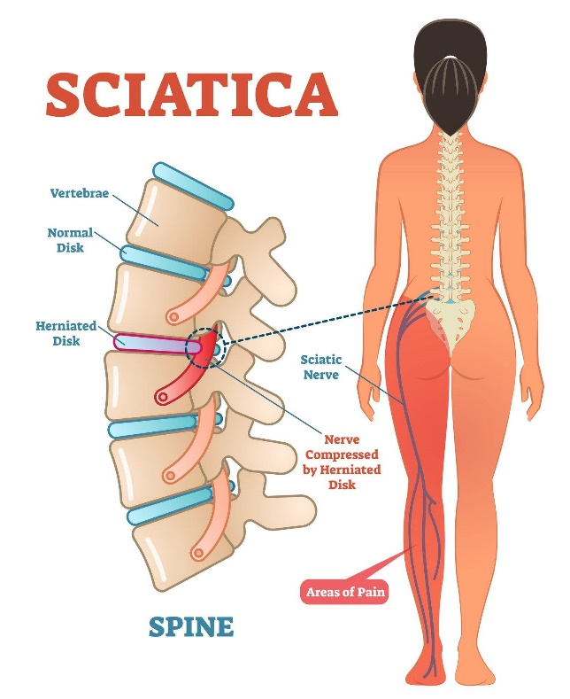 sciatica