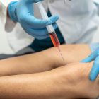 specialist-injecting-platelet-rich-plasma-prp-into-the-knee-joint
