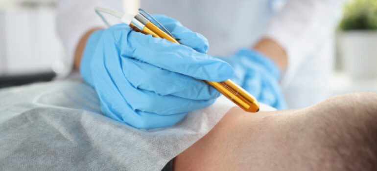 clinical-view-of-a-dry-needling-session-targeting-trigger-points-in-the-upper-trapezius-muscle