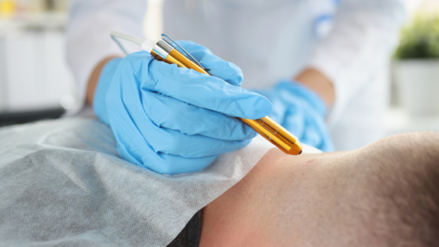 clinical-view-of-a-dry-needling-session-targeting-trigger-points-in-the-upper-trapezius-muscle