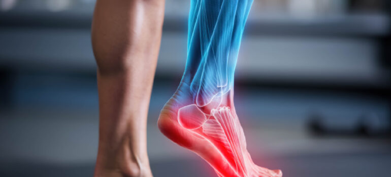 diagram-showing-the-tearing-of-lateral-ligaments-during-an-inversion-ankle-sprain