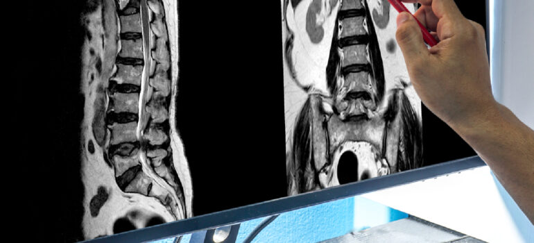 x-ray-graphic-showing-the-formation-of-osteophytes-along-a-degenerated-lumbar-spinal-segment
